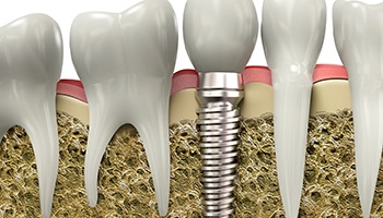 model of a dental implant fusing to the jawbone 
