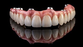 an example of implant dentures