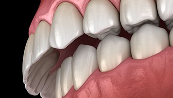 Illustration of an overbite against dark background