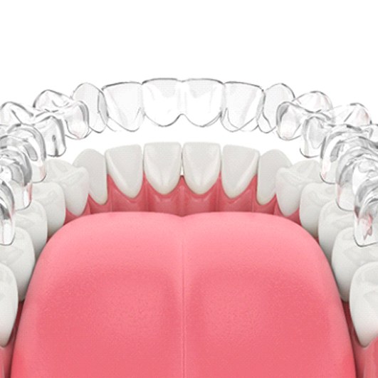 Illustration of Nu Smile Aligners in Eatontown on lower dental arch