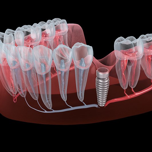 Illustration of a failed dental implant in Eatontown, NJ