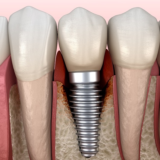 Dental implant in Eatontown, NJ with bone loss around it
